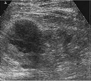 Grayscale ultrasonography showing a suspected mass-mimicking lesion in the right kidney in a 53-year-old man with clear cell renal carcinoma.