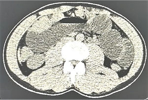 Computed tomography showing a suspected mass-mimicking lesion in the right kidney in a 55-year-old man with clear cell renal carcinoma.