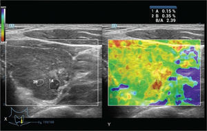 Determination of the strain index of a 42-year-old male patient with abnormal thyroid function test result. The B-to-A ratio was the strain index. X: Real-time ultrasonography. Y: Ultrasound elastography evaluation. B: Thyroid nodule strain. A: The strain of the softest area of the parenchyma. Real-time ultrasonography and ultrasound elastography were performed by ultrasound technologists with a minimum experience of 5 years.