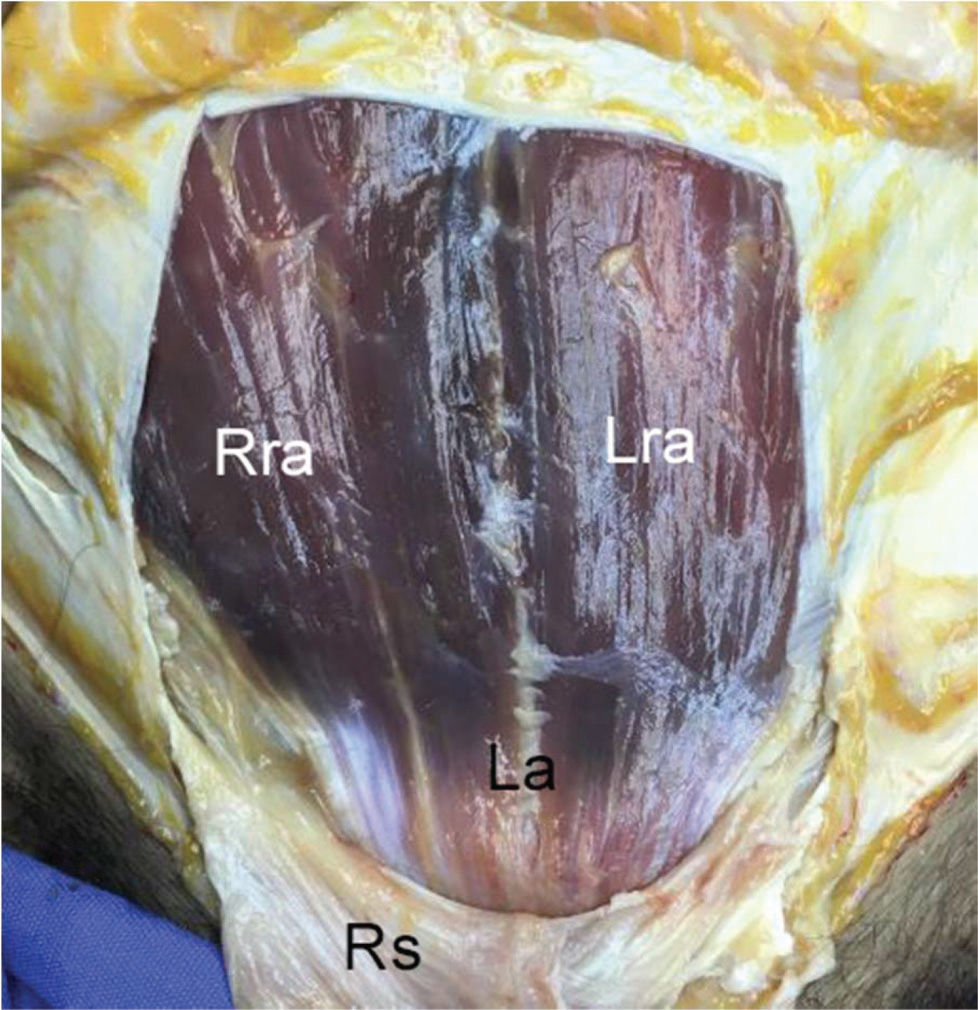 Morphometry and Frequency of the Pyramidalis Muscle in Adult Humans: A ...