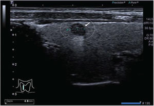 Grayscale ultrasound image of the right thyroid lobe of a 35-year-old female patient. The white circle and white arrow indicate a suspicious thyroid nodule. The maximum diameter of the nodule in the transverse view was 4.8 mm.
