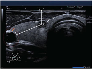 Grayscale ultrasound image of the right thyroid lobe of a 36-year-old female patient. The nodule was 3 mmin size. The white circle and white arrow indicate a suspicious thyroid nodule. The saffron circle and saffron arrow indicate the carotid artery. AB: the depth of the nodule and AC: the distance of the nodule from the carotid artery.
