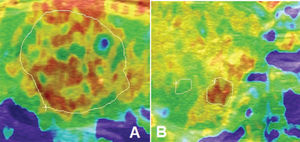 Strain ultrasound elastography of the thyroid gland. ASTERIA scoring criteria. A. Suspicious nodule located within 15 mm from the carotid artery (m=115). B. Suspicious nodule located more than 15 mm from the carotid artery (n=56).