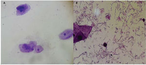 Microscopic observation (Gram staining) of the vaginal microbiota before treatment without Lactobacillus (A) and after treatment with Lactobacillus (B).