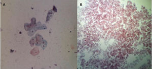Microscopic observation of the vaginal epithelial cells (Papanicolaou staining) before treatment (A) and showing the maturation of the vaginal epithelium after radiofrequency (B).