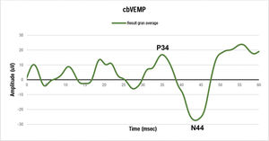 Grand average resulting from all VEMP examinations captured on the forearm, with emphasis on the P34 positive peak and the N44 negative peak.