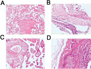 Histological changes in placental tissues obtained from preterm infants were examined by HE staining. (A) Normal placental tissue from preterm infants demonstrates no obvious pathological change (×200). (B) Chorionic membrane tissue demonstrates mild inflammatory cell infiltration (×200). (C) Acute inflammatory placental tissues show congestion and edema, with aggregated neutrophils (×200). (D) Chronic inflammatory placental tissues show necrosis, proliferation, neutrophils, lymphocytes, and monocytes (×200). HE, hematoxylin and eosin.