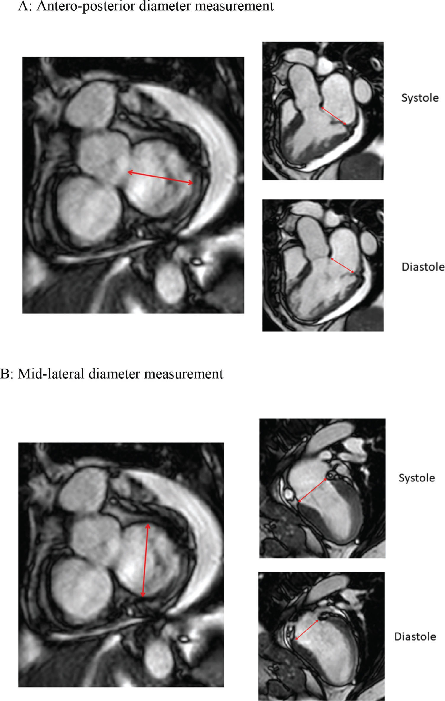 Anular Repad Cardiac Magnetic Resonance Analysis of Mitral Annular Dynamics after ...