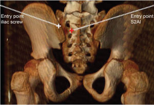 Example of the S2-alar-iliac screw (shown by the red cross) and the iliac screw (shown by the white cross) entry points.