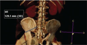 Example of iliac screw length measurement (shown by white line).