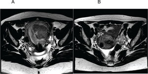 A. Axial section of the pelvis before arterial embolization of myomas (AEM) showing a submucosal mass with an intramural component; B. Axial section of the pelvis 6 months after AEM showing absence of the previously characterized myometrial mass and a subserous residual fundic/cicatricial nodule.