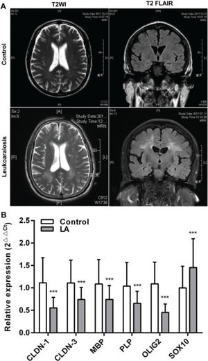 White matter (WM) lesions visualized in normal controls and patients with LA and the relative expression of claudins. (A) The magnetic resonance imaging (MRI) exhibits symmetrical deep lesions located in the periventricular white matter, which showed high signals in T2WI and T2 FLAIR. (B) The expression of claudins (CLDN-1 and CLDN-3) and myelinogenesis-related genes (MBP, PLP, OLIG2, and SOX10) in patients with LA. ***p<0.001 versus the respective control.