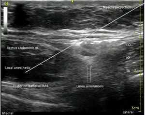 US image, with the projection of the needle position, and the local anesthetic spread between the RA muscle and posterior leaflet of RAS. EO: external oblique muscle; IO: internal oblique muscle; TA: transverse abdominis muscle.
