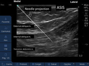 US image, with the projection needle, with the tip located in the plane between the IO and TA muscles. ASIS: anterior superior iliac spine.