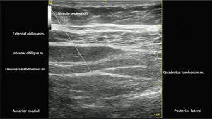 US image with needle position projection. The tip is located deeper than the TA muscle, laterally to the lateral border of the QL muscle.