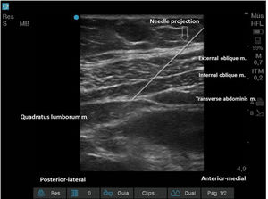 US image, with needle projection. Its tip is located on the posterior-lateral border of the TA muscle, posterior to the QL muscle.