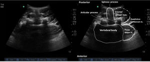 US image of the transducer on the posterior midline in the transverse position. Spine vertebrae and important paravertebral structures for trans-muscular QL block.