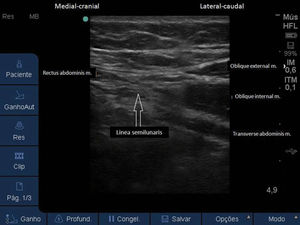 Ultrasound image with visualization of the lateral portion of the RA muscle, linea semilunaris and abdominal muscles planes laterally.