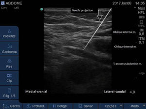 Ultrasound image showing the proper position of the needle tip in the plane between the IO and TA muscles.