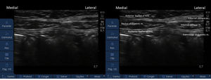 Ultrasound image of the RA muscle enveloped by its sheath and the plane muscles, laterally.