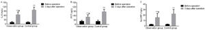 Intergroup comparison of serum inflammatory reactivity. At 3 d after LC, the serum IL-6, PCT, and hs-CRP levels increased in both groups but were lower in OG than in CG (p<0.05) A: IL-6; B: PCT; C: hs-CRP. Note: ***p<0.05 versus preoperative values.