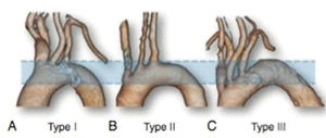 Aortic arch classification.
