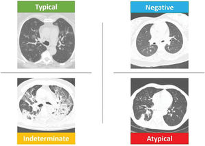 Schematic representation of the RSNA classification. The upper left image shows “typical” CT findings of COVID-19 with multifocal rounded ground-glass opacities. The lower left image shows an “indeterminate” CT findings of COVID-19 with perihilar bilateral opacities and a lack of “typical” tomographic findings. The lower right image shows “atypical” CT findings of COVID-19 with lower lobe consolidation and bilateral “tree-in-bud” images. The upper right image shows “negative” CT findings without signs of infection. COVID-19, Coronavirus disease; CT, computed tomography; RSNA, Radiological Society of North America.