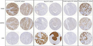 TMA cores stained with CK20, GATA3 and CK5 showing representative cases grouped as luminal, basal, double-negative and double-positive immunohistochemical subtypes.