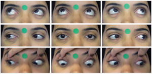 Photographs in the nine positions of gaze.