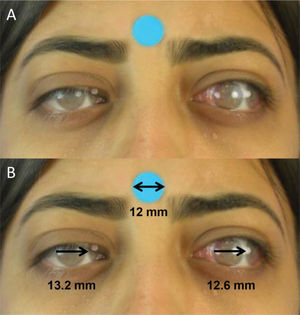 A. Juxtaposition of semitransparent images of primary gaze and levoversion (Photoshop) for quantitative version evaluation.B. Evaluation of levoversion. Right eye: In adduction, the distance between the lateral limbi of the juxtaposed photos is measured (ImageJ). Left eye: In abduction, the distance between the medial limbi is measured (ImageJ).