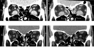 Computed tomography measurements of the recti muscle areas. A and B. Preoperative (A) and postoperative (B) measurements of a patient submitted to inferomedial wall orbital decompression (IM-OD). C and D. Preoperative (C) and postoperative (D) measurements of a patient submitted to balanced medial plus lateral wall orbital decompression (ML-OD).