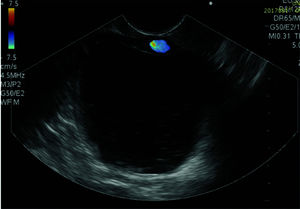 Identification of pancreatic pseudocysts on an endoscopic ultrasound image Doppler ultrasound was used to assess the gastric or duodenal wall for interposed vessels.