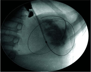Introduction of a 0.035-inch guidewire by the puncture needle until it formed two loops inside the cyst under fluoroscopic guidance.