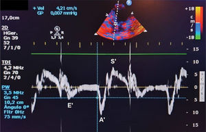 Septal tissue Doppler in the apical window four-chamber view to assess the velocity of mitral annular systolic (S') and diastolic excursion in the early filling phase (E') and atrial contraction phase (A').
