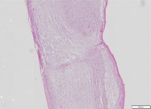 Spinal cord fragment. Sagittal cutting microscopy of spinal cord fragment, animal 7 of group 4. Hematoxylin-eosin staining showing histological features with almost complete interruption of neural bundles, hemorrhage (1+), architectural changes (3+), necrosis (2+) and inflammatory infiltrate (1+). Photo obtained using the Olympus scanner, model VS120, 20x lens.