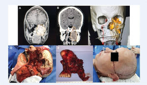 An extensive adenoid cystic carcinoma with skull base invasion submitted to craniofacial resection and microsurgical free flap reconstruction. No major complications. Images A, B, and C show preoperative scans showing a large tumor involving the maxilla and middle fossa; D, the surgical defect after en bloc tumor resection; E, the surgical specimen; and F, the immediate result after reconstruction.