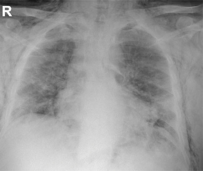 Spontaneous Pneumomediastinum Incidence And Clinical Features In Non spontaneous-pneumomediastinum-incidence-and-clinical-features-in-non