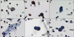 A,B) Photomicrographs of CTCs isolated from breast cancer patients immunostained for estrogen receptor and progesterone receptor, respectively (counterstaining with DAB). C) CTCs visualized by hematoxylin, without any antibody staining. D) One CTM was observed in the filtered blood from a patient with breast cancer. E,F) Positive controls, MCF-7 cells “spiked” in healthy blood and stained for estrogen receptor and progesterone receptor respectively. Both images were taken at 400× magnification using a light microscope (Research System Microscope BX61; Olympus, Tokyo, Japan) coupled to a digital camera (SC100; Olympus). Abbreviations: CTCs, circulating tumor cells; DAB, 3,3′-daminobenzidine; CTM, circulating tumor microemboli.