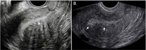 Two-dimensional ultrasound imaging of a uterus in a longitudinal section showing typical sonographic features of adenomyosis. A. Note the asymmetry of the myometrial wall (posterior wall thicker than anterior wall) and the heterogeneous myometrium with hypoechoic linear striae (arrows). B. Poorly defined junctional zone (arrows).