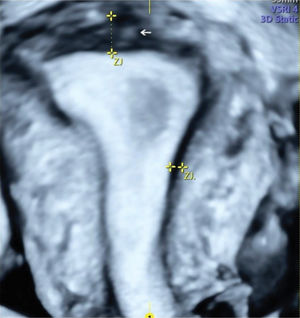 Three-dimensional ultrasound imaging of a uterus in the coronal plane showing focal adenomyosis of the inner myometrium: junctional zone interrupted with one hyperechogenic island (arrows).