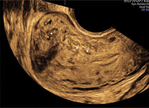 Two-dimensional ultrasound imaging of a uterus in the sagittal plane showing a focal adenomyosis of the outer myometrium: a heterogeneous uterus with adenomyoma and an irregular junctional zone (arrows and asterisks).
