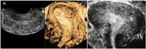 Two and three-dimensional ultrasound imaging of a uterus with diffuse type adenomyosis. A. Heterogeneous uterus with an irregular and interrupted junctional zone associated with myometrial cysts (arrows). B. Severe diffuse adenomyosis. Globular, enlarged, and heterogeneous uterus with myometrial cysts and an ill-defined junctional zone, completely infiltrated by adenomyosis (arrows and asterisks).