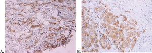 Lewis Y antigen expression of the patient with stable disease for more than 2 years who was administered hu3S193 according to immunohistochemistry. A. Predominant membrane Lewis Y staining ×200. B. Membrane and cytoplasm Lewis Y staining ×200.