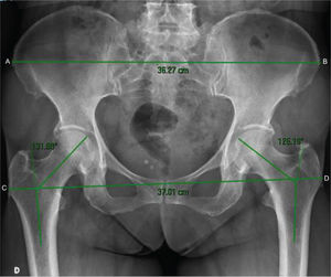 Distances between the greater trochanter and iliac crest and demonstration of the measurement of the femoral neck-shaft angle. AB, distance between the external lateral ends of the iliac crest; CD, distance between the most lateral ends of the greater trochanters; CD/AB, pelvic-trochanteric index.