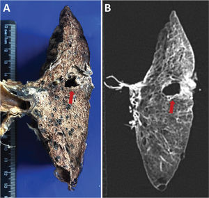 Male, 89 years old, 7 days of hospitalization, same patient as in Figure 3A and 3B. Ex-situ computed tomography (B) showing perfect correlation with the macroscopic evaluation of the lung (A), ground-glass opacities, peripheral reticular pattern, and an area of lung cavitation (arrow in A and B), likely resulting from a previous abscess, with fistula formation toward the pleura.