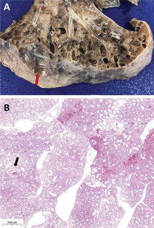 Female, 17 years old, 20 days of hospitalization, 16 days of mechanical ventilation. Bilateral pneumothorax and subcutaneous emphysema in the chest and face reported 9 days before death. A: Multiple areas of pulmonary interstitial emphysema secondary to barotrauma. Note a ruptured subpleural bubble (arrow). B: Pulmonary interstitial emphysema; air dissects along connective tissue sheaths of the bronchovascular bundles and interlobular septa. Arrow: arteriolar thrombus.