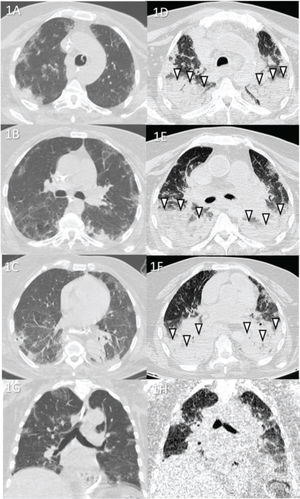 Case 1: Premortem axial chest computed tomography (CT) of the upper (A), mid (B), and inferior (C) thirds of the lungs obtained 2 days before death showing peripheral ground-glass opacities, slight consolidations, and interlobular septal thickening. Postmortem axial chest CT of the upper (E), mid (F), and inferior (G) thirds of the lungs obtained 4 h 47 min after death showing opacities larger than those on premortem CT, thus demonstrating the progression of the disease until death. Postmortem posterior “horizontal level forming” consolidations because of hypostasis (white arrowheads) are also observed, which limited analysis of the posterior lungs in this case (limitation of the method). Images D and H show pre- and postmortem coronal reformats, respectively.