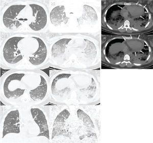 Case 2: Premortem axial chest computed tomography (CT) of the upper (A), mid (B), and inferior (C) thirds of the lungs obtained 2 days before death showing peripheral ground-glass opacities, small posterior bilateral consolidations, and right pleural effusion. Postmortem axial chest CT of the upper (E), mid (F), and inferior (G) thirds of the lungs obtained 14 h 03 min after death showing a diffuse “crazy paving” pattern, possibly because of acute respiratory distress syndrome and subsequent death. Furthermore, the posterior bilateral consolidations are larger on postmortem CT than on premortem CT, indicating progression of the disease. Images D and H show pre- and postmortem coronal reformats, respectively. Postmortem axial chest CT (I and J) of the mediastinal window showing pericardial effusion (white arrows) related to myopericarditis (confirmed with the collected tissue sample as the probable cause of death).