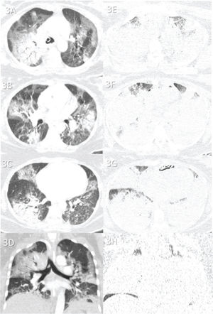 Case 3: Premortem axial chest computed tomography (CT) of the upper (A), mid (B), and inferior (C) thirds of the lungs obtained 2 days before death showing patchy peripheral and central ground-glass opacities and bilateral but mainly peripheral consolidations. Postmortem axial chest CT of the upper (E), mid, (F) and inferior (G) thirds of the lungs obtained 17 h 19 min after death showing rapid progression of the disease, with extensive consolidations in both lungs and a few areas of preserved pulmonary parenchyma. Images D and H show pre- and postmortem coronal reformats, respectively.