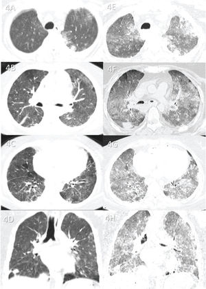 Case 4: Premortem axial chest computed tomography (CT) of the upper (A), mid (B), and inferior (C) thirds of the lungs obtained 1 day before death showing peripheral ground-glass opacities and diffuse pulmonary mosaic attenuation because of ventilation and/or perfusion disturbances (small hypoattenuating areas in the lungs). Postmortem axial chest CT of the upper (E), mid (F), and inferior (G) thirds of the lungs obtained 18 h 20 min after death showing ground-glass opacities larger than those on premortem CT and associated with small consolidations, indicating progression of the disease before death. Because the postmortem CT is of expired lungs, the pulmonary mosaic attenuation is enhanced. This confirms that the small hypoattenuating lung areas on premortem CT are air-trapping areas on postmortem CT. Images D and H show pre- and postmortem coronal reformats, respectively.